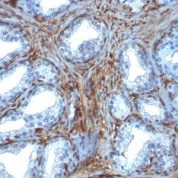 FFPE human prostate carcinoma sections stained with 100 ul anti-Galectin-1 (clone GAL1/1831) at 1:100. HIER epitope retrieval prior to staining was performed in 10mM Citrate, pH 6.0.